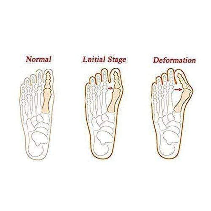 Bunion Corrector Splint Wrap - Big Toe Straightener Bunion Corrector upliftex