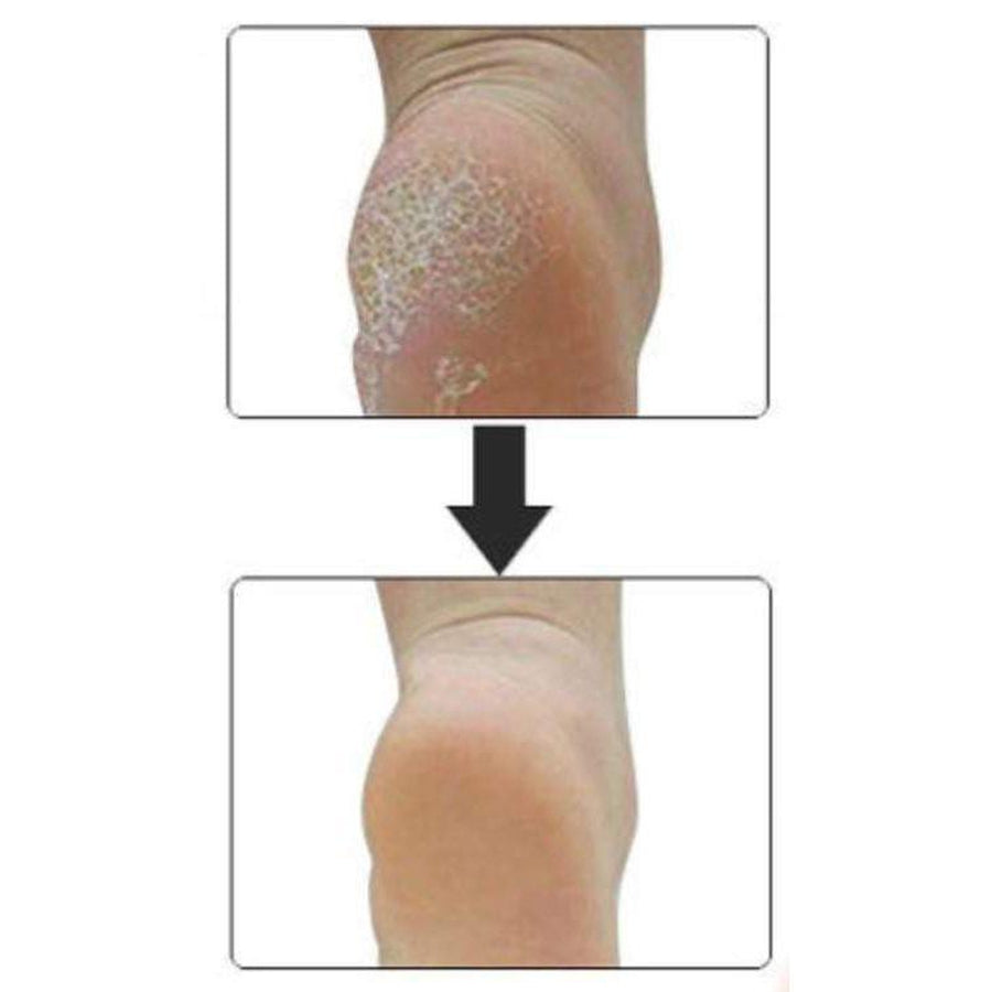 Heel Spur Relief - Plantar Fasciitis Gel Cup Massage Pads